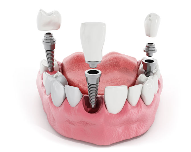 dental implant model