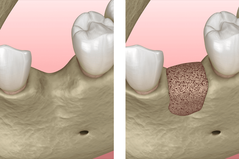 bone grafting graphic