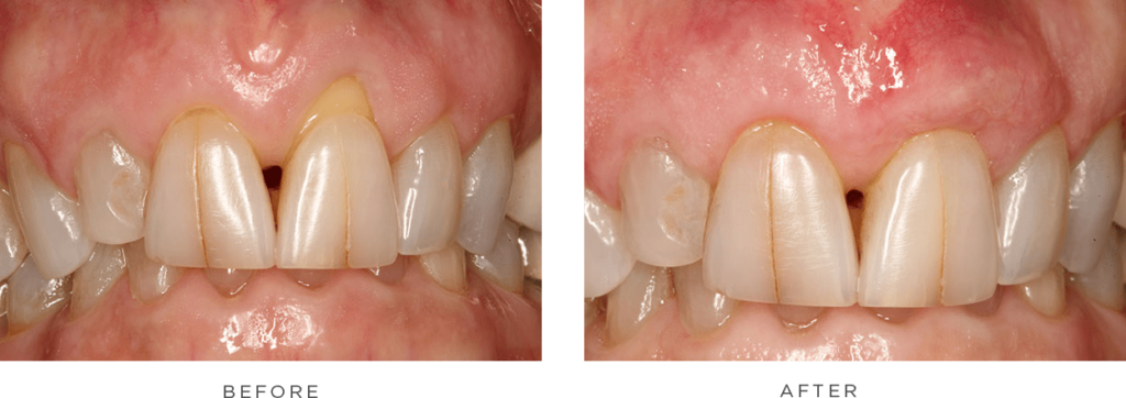 case 1 before and after