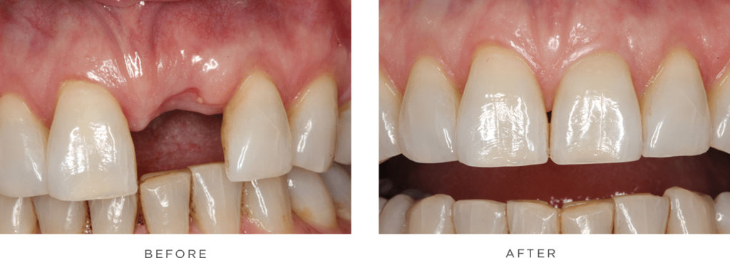 case 2 before and after
