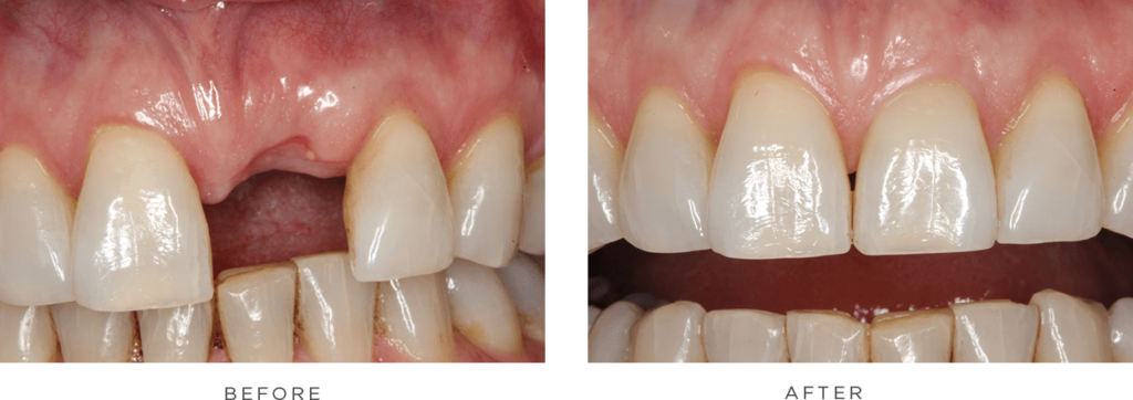 case 2 before and after