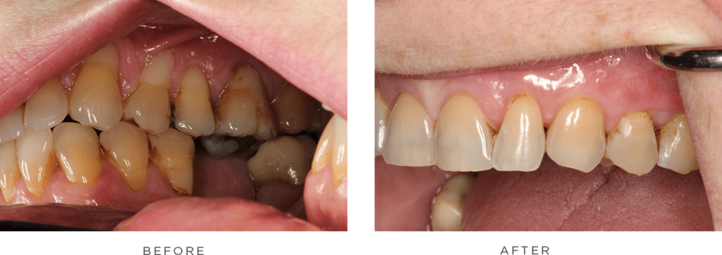 case 4 before and after