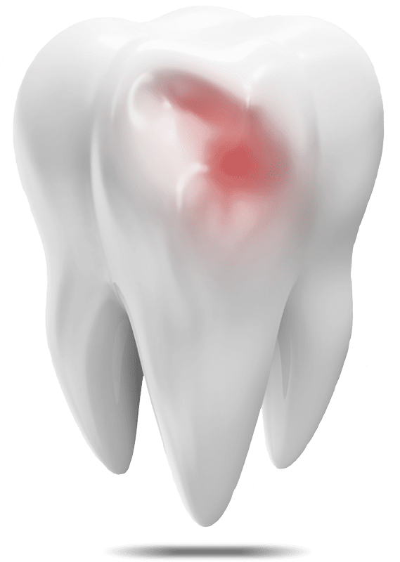 damaged tooth model