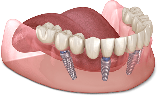 full mouth dental implant model