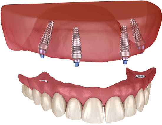 implant supported denture model